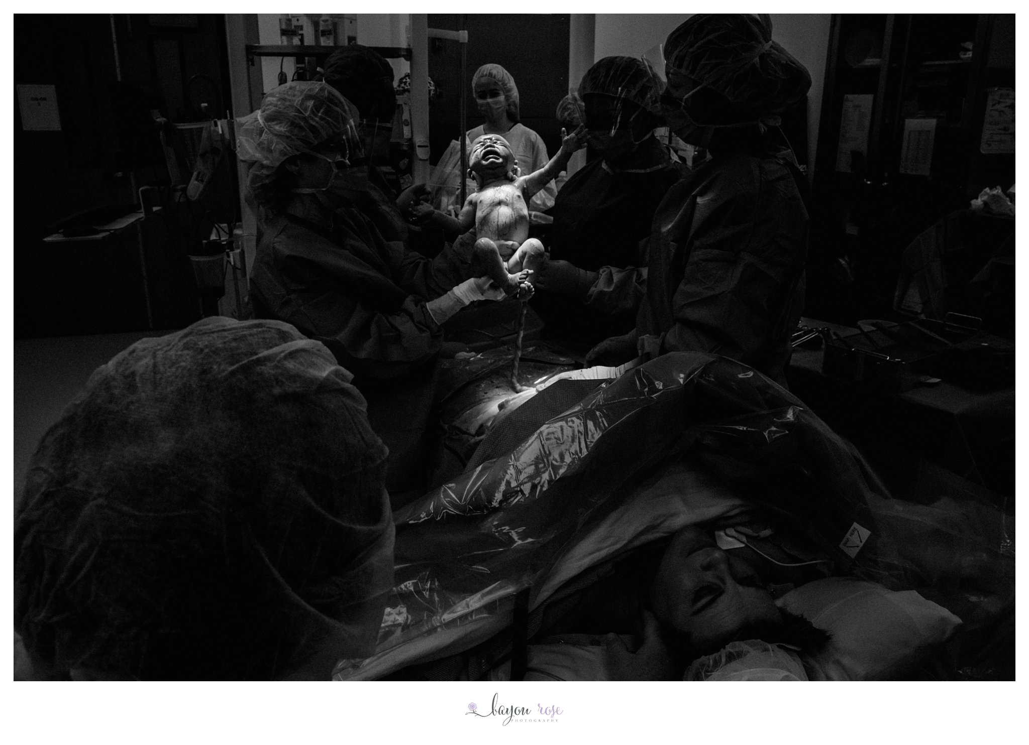dramatic black and white photo of baby being born during c-section delivery